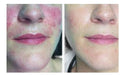 Genérica Tratamiento Facial Para Rosacea, Sesion, Villa Crespo 4