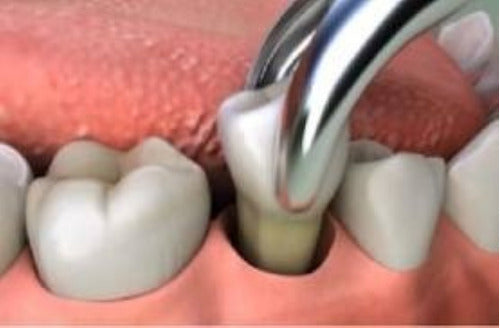 Exodoncia Extraccion Dentaria Diente Simple 1