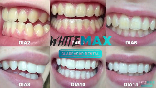 1 Clareador Dos Dentes Consultorio Kelly Key 2