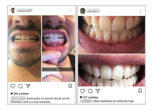 1 Clareador Dental Caseiro Valor 2019 Paulo Zulu 5