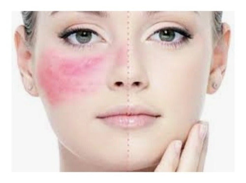 Genérica Tratamiento Facial Para Rosacea, Sesion, Villa Crespo 0