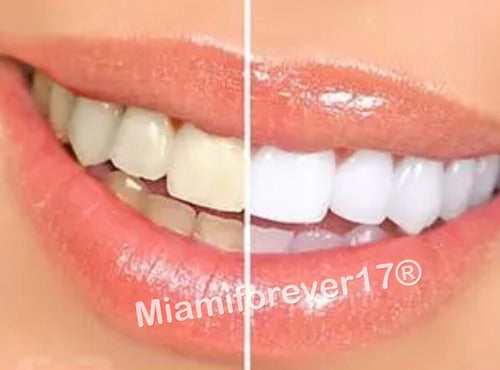 Whitening Set Blanqueador Dientes Blancos 44% 10 Jeringas 1