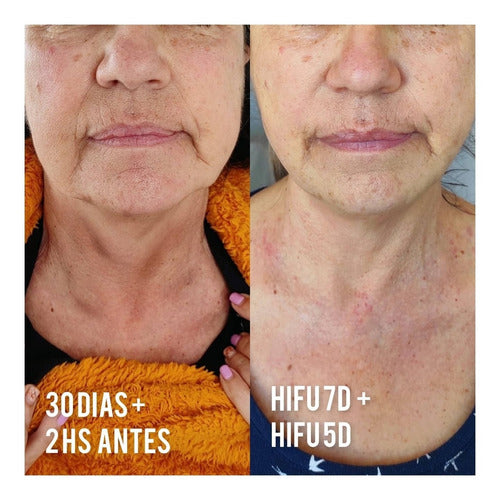 David G. Hayek Efecto Tensor Antiarrugas Lifting Con Hifu Rostro Completo 3