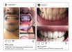 3 Clareamento Dental De Dentes Mercado Livre Natural 3