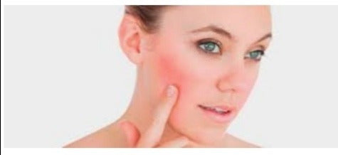 Genérica Tratamiento Facial Para Rosacea, Sesion, Villa Crespo 1