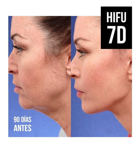 David G. Hayek Efecto Tensor Antiarrugas Lifting Con Hifu Rostro Completo 4