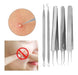 Extractor Tool System for Blackhead Removal 3