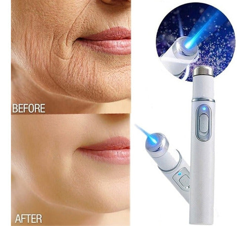 DD2 Laser Machine for Removing Tattoos, Acne, and Skin Blemishes - UV Light Skin Repair 5