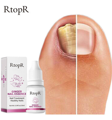 RtopR Nail Repair Cream with Ginger for Fungal Infections! 0