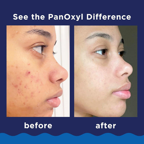 PanOxyl Anti-Acne Foaming Wash Benzoyl Peroxide 10% 156g 1