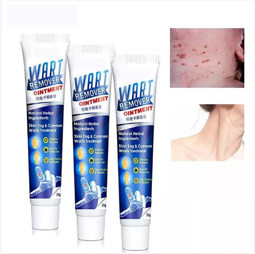 Wart Treatment Cream Callus Remover Imported 5