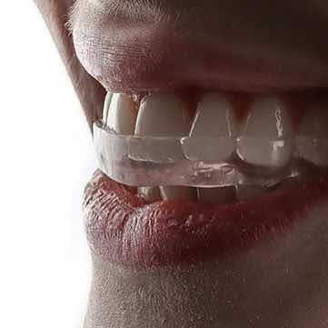 Relaxing Bruxism Mouthguard/Protector. Same-Day Delivery! Quilmes 0