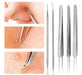 Extractor Tool System for Blackhead Removal 0